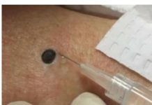 ŽENA JE GAJILA OVO NA LEĐIMA: Kada je doktorka uzela špric i bocnula, shvatit ćete zašto je SNIMAK pregledalo 33 miliona ljudi!