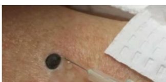 ŽENA JE GAJILA OVO NA LEĐIMA: Kada je doktorka uzela špric i bocnula, shvatit ćete zašto je SNIMAK pregledalo 33 miliona ljudi!