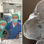 DETALJI ČUDA S REBRA Na pola porodili dijete da izvade tum0r: Dio bebe bio je u maternici! DETALJI ČUDA S REBRA Na pola porodili dijete da izvade tumor. Dio bebe bio je u maternici! - featured image