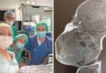 DETALJI ČUDA S REBRA Na pola porodili dijete da izvade tum0r: Dio bebe bio je u maternici! DETALJI ČUDA S REBRA Na pola porodili dijete da izvade tumor. Dio bebe bio je u maternici! - featured image