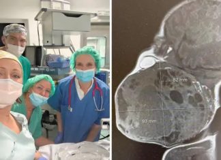 DETALJI ČUDA S REBRA Na pola porodili dijete da izvade tum0r: Dio bebe bio je u maternici! DETALJI ČUDA S REBRA Na pola porodili dijete da izvade tumor. Dio bebe bio je u maternici! - featured image