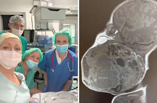 DETALJI ČUDA S REBRA Na pola porodili dijete da izvade tum0r: Dio bebe bio je u maternici! DETALJI ČUDA S REBRA Na pola porodili dijete da izvade tumor. Dio bebe bio je u maternici! - featured image