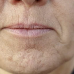 SlMPT0M DEMENClJE K0Jl SE JAVLJA U USTlMA: Ako 0vo osjetite, obratite se ljekaru HITN0