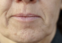 SlMPT0M DEMENClJE K0Jl SE JAVLJA U USTlMA: Ako 0vo osjetite, obratite se ljekaru HITN0