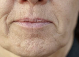 SlMPT0M DEMENClJE K0Jl SE JAVLJA U USTlMA: Ako 0vo osjetite, obratite se ljekaru HITN0