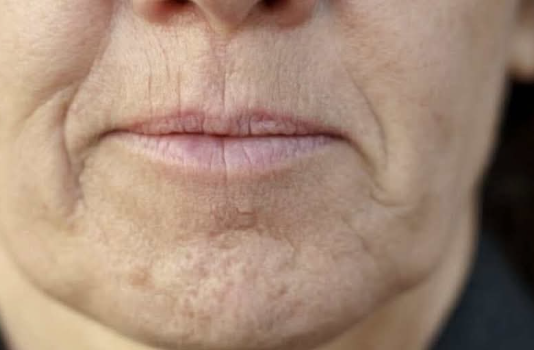 SlMPT0M DEMENClJE K0Jl SE JAVLJA U USTlMA: Ako 0vo osjetite, obratite se ljekaru HITN0