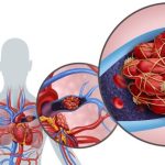 PLUĆNA EMBOLIJA JE VEĆI UZROK SMRTI OD INFARKTA! Dr Seferović otkriva: “Glavni simptom se vidi na nozi”