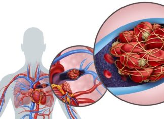 PLUĆNA EMBOLIJA JE VEĆI UZROK SMRTI OD INFARKTA! Dr Seferović otkriva: “Glavni simptom se vidi na nozi”