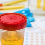 BOJA URINA otkriva mnoge ozbiljne bolesti, pa čak i one NAJTEŽE – Ovo je RAZLOG zbog kog vam je MOKRAĆA MUTNA