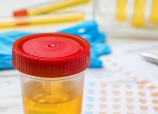 BOJA URINA otkriva mnoge ozbiljne bolesti, pa čak i one NAJTEŽE – Ovo je RAZLOG zbog kog vam je MOKRAĆA MUTNA