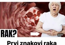 Simptomi raka debelog crijeva kod žena koje trebate znati
