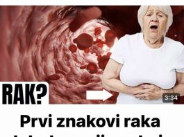 Simptomi raka debelog crijeva kod žena koje trebate znati