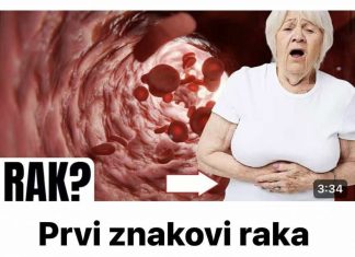 Simptomi raka debelog crijeva kod žena koje trebate znati